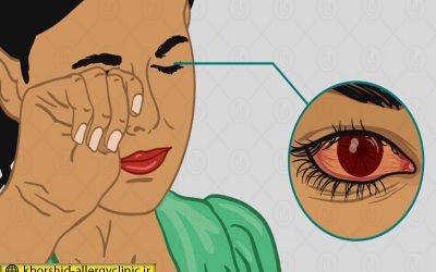 آنچه که لازم است در مورد آلرژی چشم بدانید !