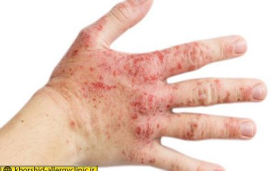 درماتیت آتوپیک، نوعی اگزمای پوستی