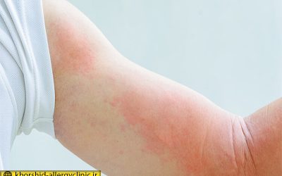 تاثیر کرونا بر روی پوست و شناخت علائم آن