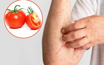 آلرژی به گوجه فرنگی (علل و روش های درمان)