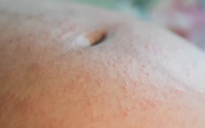 کهیر در بارداری؛ علل، علائم، پیشگیری و روش های تشخیص و درمان