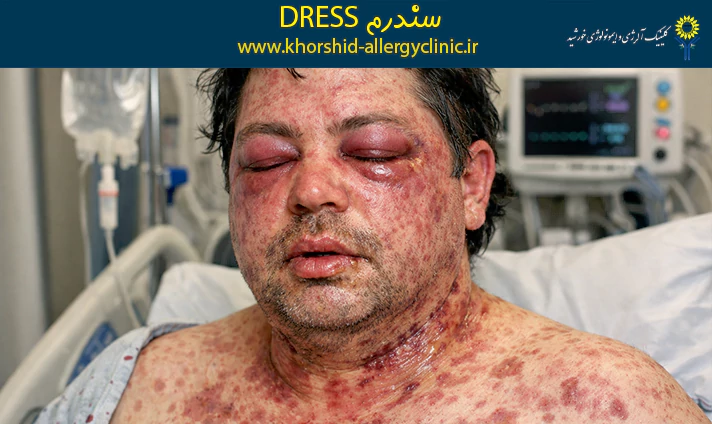 سندرم DRESS