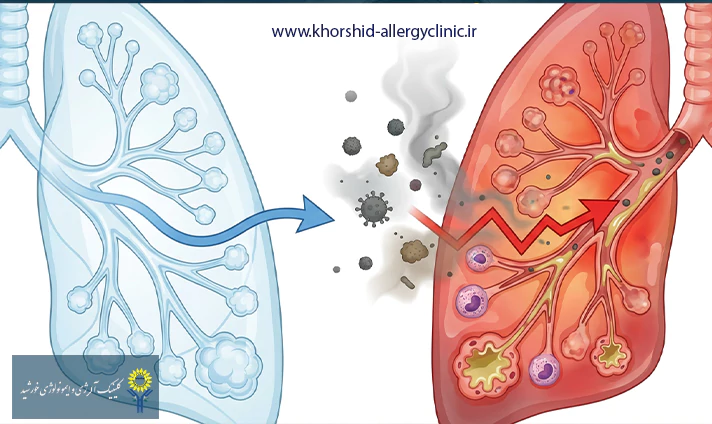 چگونه آلودگی هوا باعث بدتر شدن علائم آسم میشود؟