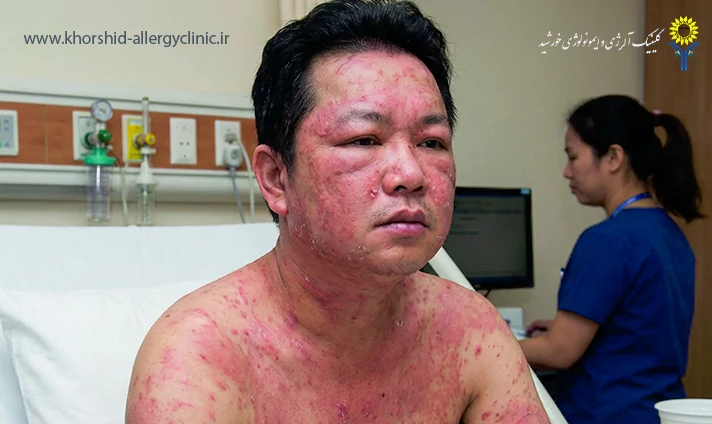 علل سندرم درس