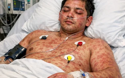 سندرم DRESS؛ عارضهای نادر اما خطرناک با علائم پنهان