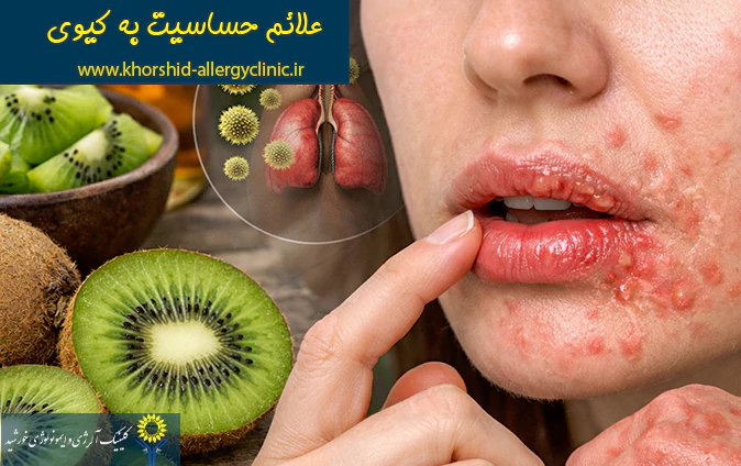 علائم حساسیت به کیوی